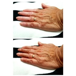 camouflage vitiligo hands lotion before after