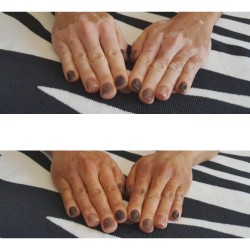 Camouflage vitiligo hands before after
