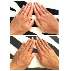 loción de manos camuflaje vitiligo antes después