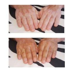 Camuffamento delle mani di vitiligine prima e dopo
