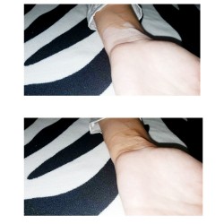 Vitiligo wrist camouflage before after