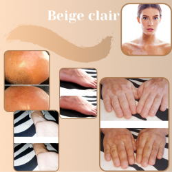 Camouflage vitiligo avant après