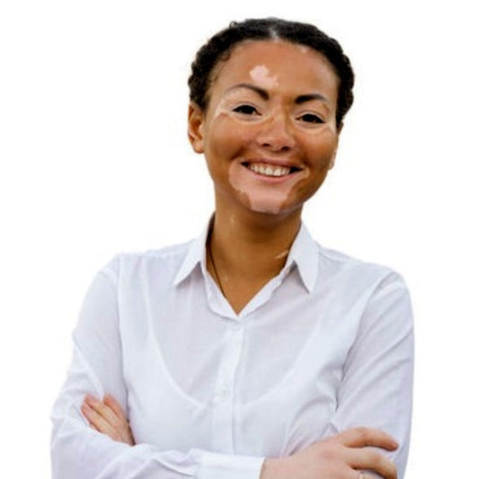 Vitiligo et exposition au soleil : ce qu’il faut savoir