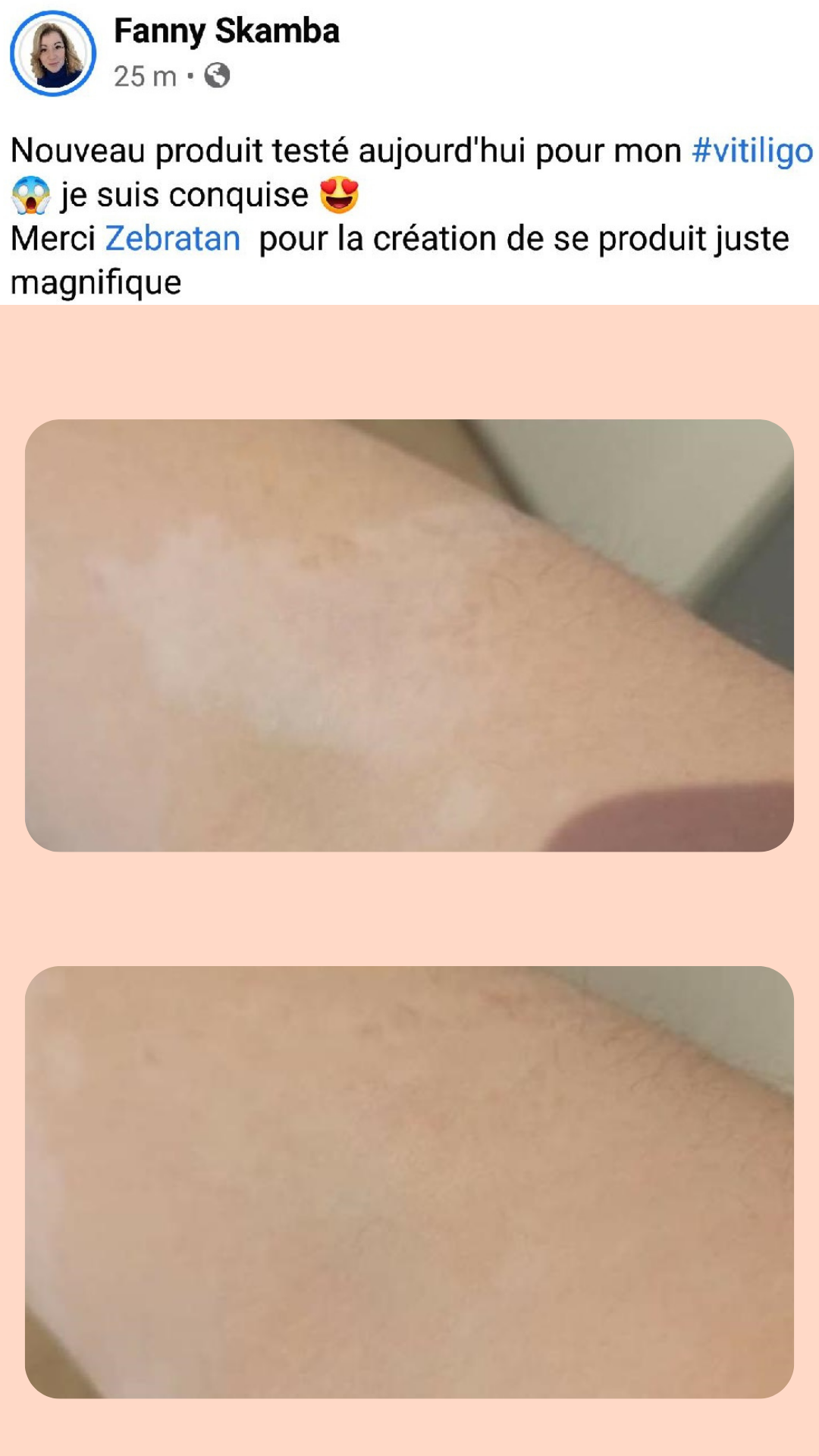 vitiligo avant après